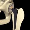 Coxartrosi