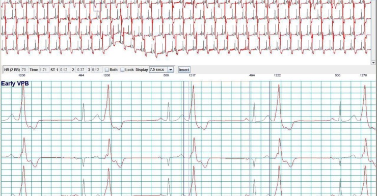 Holter