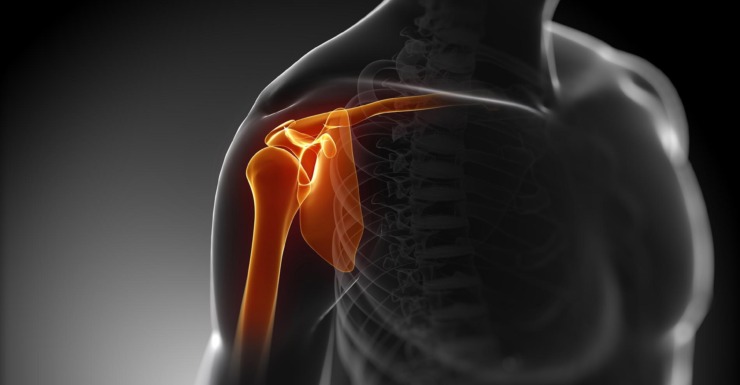 Sindrome da Impingement
