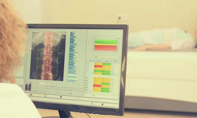 L’osteoporosi, malattia silenziosa: quando prevenire è vitale