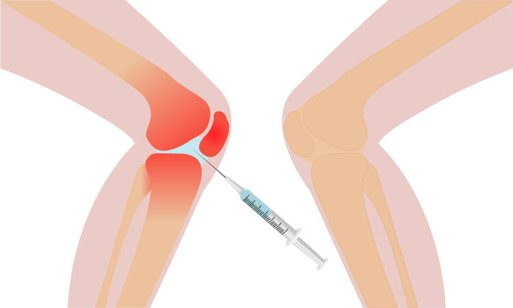 L’infiltrazione endoarticolare: di cosa parliamo?