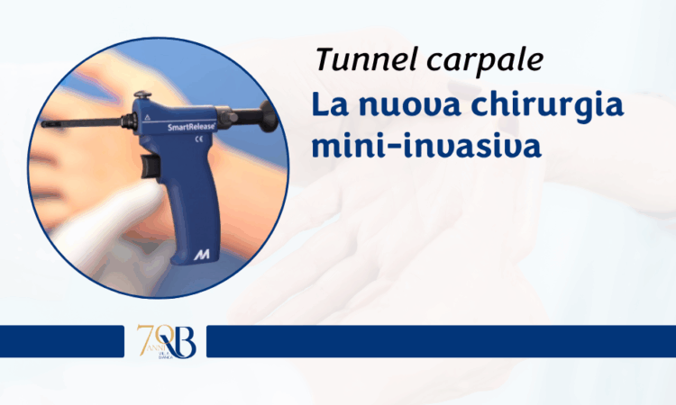 Tunnel carpale: la nuova chirurgia mini-invasiva che riduce dolore e tempi di recupero